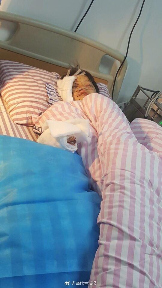 充电手机突然爆炸 广西12岁男孩手指被炸断眼球被炸伤